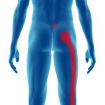 Pain caused by sciatic nerve into buttock and leg