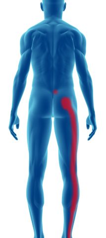 Pain caused by sciatic nerve into buttock and leg