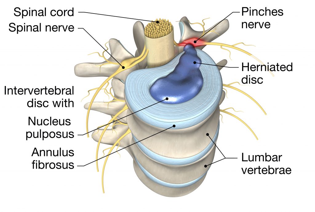 illustration showing lumbar vertebra with intervertebral disc bulge 