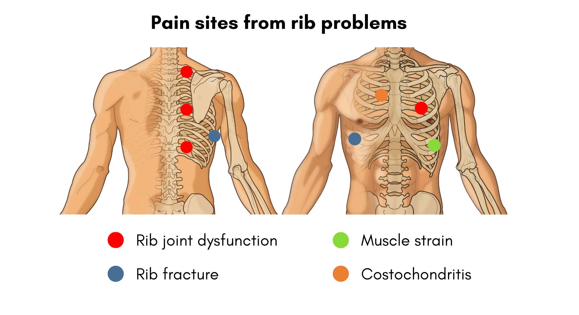 Treating Intercostal Muscle Strain