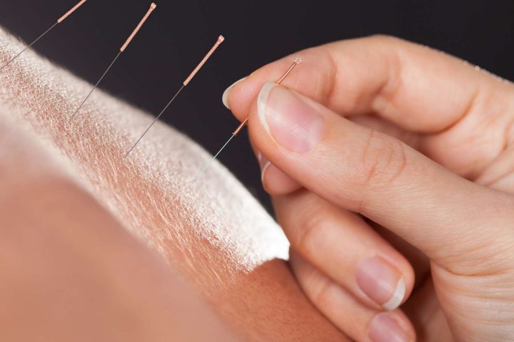 Acupuncture For Chronic Pain: Everything You Need To Know